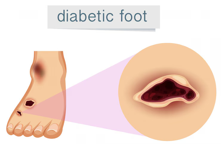 Diabetic foot treatment in Ludhiana